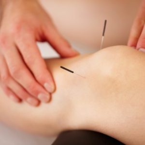 View of woman's leg with acupuncture needles